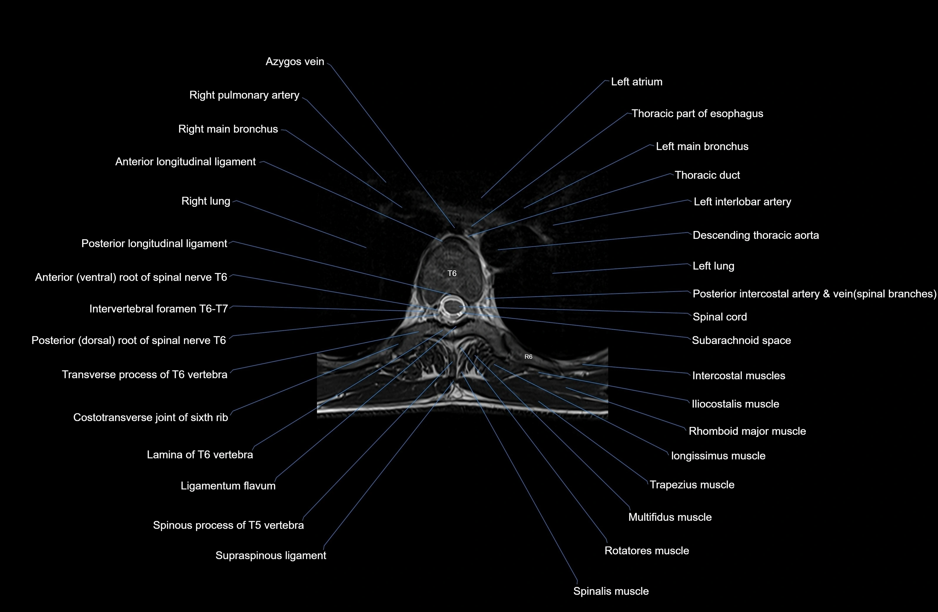 MRI thoracic spine axial  cross sectional anatomy 3T radiology  image-img-00001-00039.webp